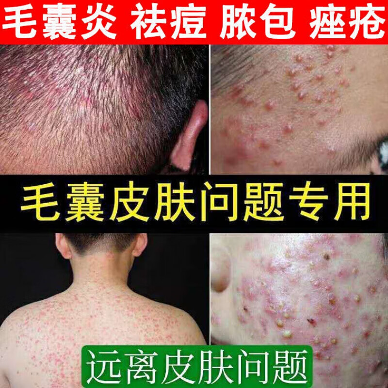 炎脓包硬块疙瘩大脓包痘痘坐扳疮屁真菌感染胸背刺痒长痘脓包止痒膏