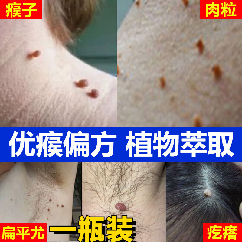 帅榜贝因维丝beiyvs去l除l脖子上的小肉粒瘤猴子脖子上长的疙瘩痦子腋