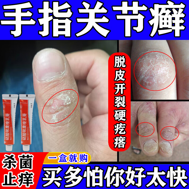 手指关节癣皮肤手癣真菌感染药膏脱皮开裂手脱皮严重脱皮真菌蜕皮干燥