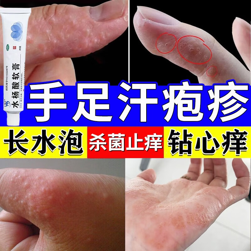 汗疱疹药膏 手上起小水泡脱皮很痒手痒 消炎止痒膏湿疹皮炎瘙痒难忍