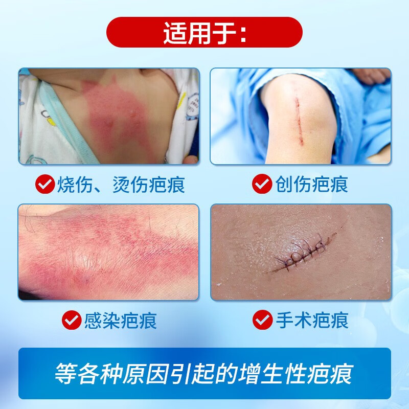 欣奕除疤凝胶壳聚糖季铵盐硅凝胶改善疤痕增生 【10g+剖腹产贴3片】组合