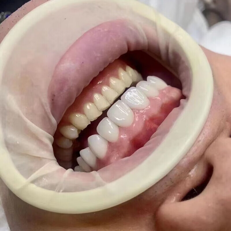 牙科橡皮障开口器 义获嘉三维立体o型开口器医用蓝白色橡胶开口 白色1