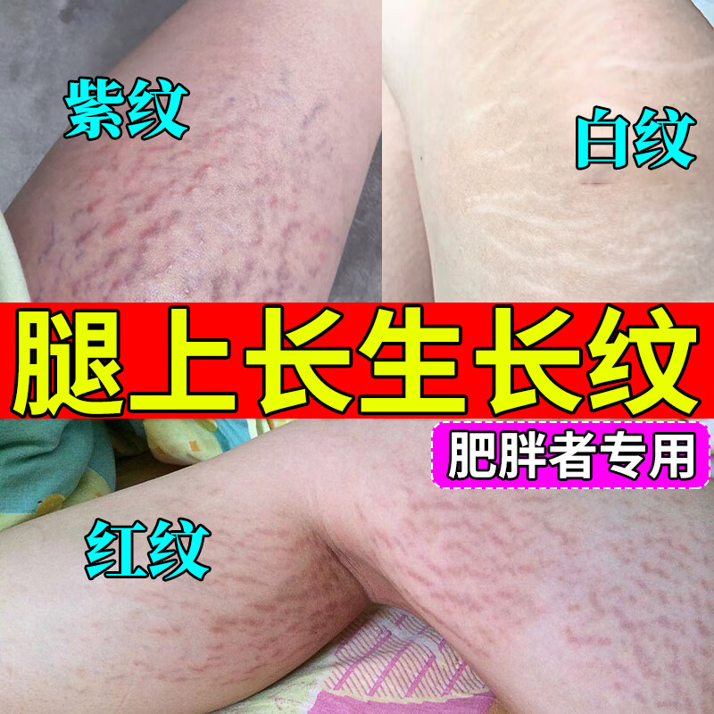 去肥胖纹生长纹消除大腿学生肚子屁股 青少年生长纹消除去妊娠纹肥胖