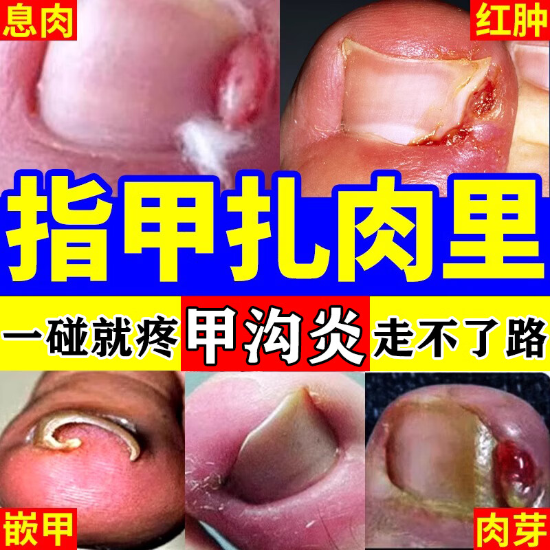 治甲沟炎的药 抗真菌药膏克霉唑乳膏 1盒装【指甲嵌肉里】1包棉签