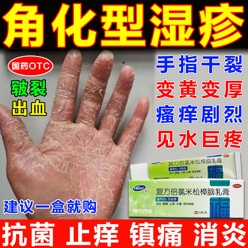 手部角化型湿疹药 手指皲裂性湿疹药膏止痒去皮炎湿疹用药 手指脱皮