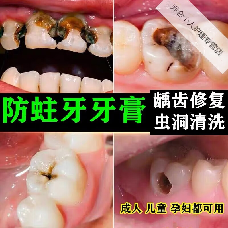 儿童防蛀牙牙膏修复牙洞龋齿黑斑牙齿痛儿童祛除i虫牙菌斑牙疼口i臭
