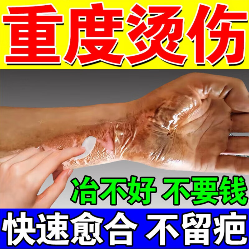 century kudos烫伤膏烧伤膏热油开水烫伤开水热油灼烧伤快速愈合不留