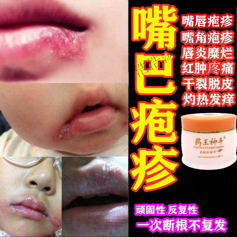 嘴巴嘴角嘴唇疱l疹唇l炎上l火起水泡糜烂炎唇膏干裂起皮脱皮专用乳膏