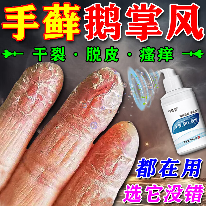 鹅掌风专用l药手足干裂脱皮掉屑红斑开裂瘙痒手癣真菌感染手掌手指