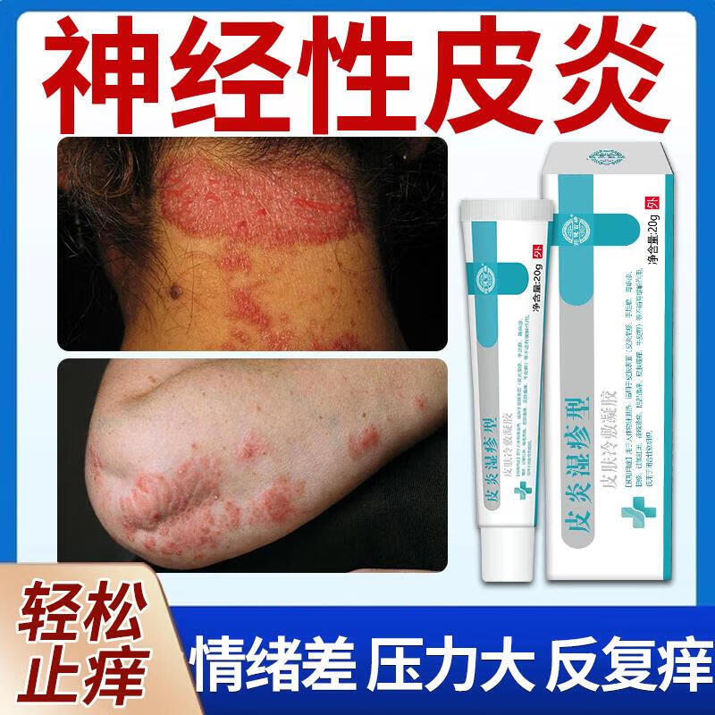 神经性皮炎专药用 顽固特效无激素过敏性皮炎湿疹皮癣真菌病皮肤瘙痒