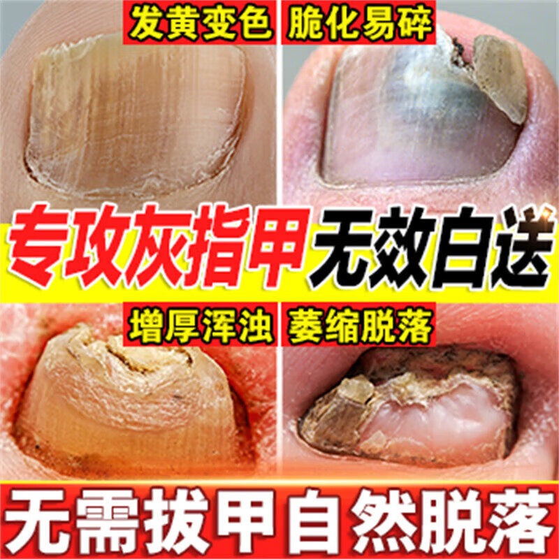 灰指甲药膏指甲真菌感染脱甲 灰指甲甲沟炎专用药根治正品真菌感染治