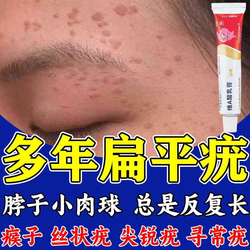 维a酸乳膏治面部脖子瘊子肉粒疙瘩痤疮丝状疣跖疣鸡眼祛疣膏皮肤用