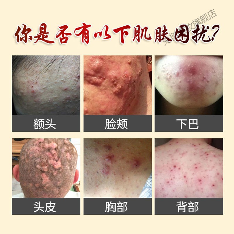 蠕形螨毛囊头部背部胸部额头脓包痘痘疙瘩痒溢脂性【草本萃取】止痒膏