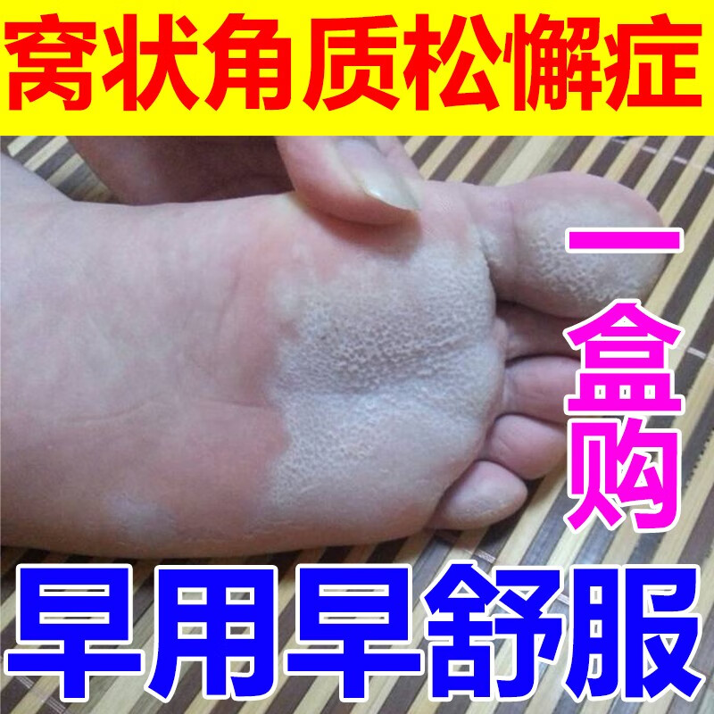 窝状角质松懈症脚底起泡发白糜烂窝状沙虫角质型脚臭脚痒蜂窝状脚 单