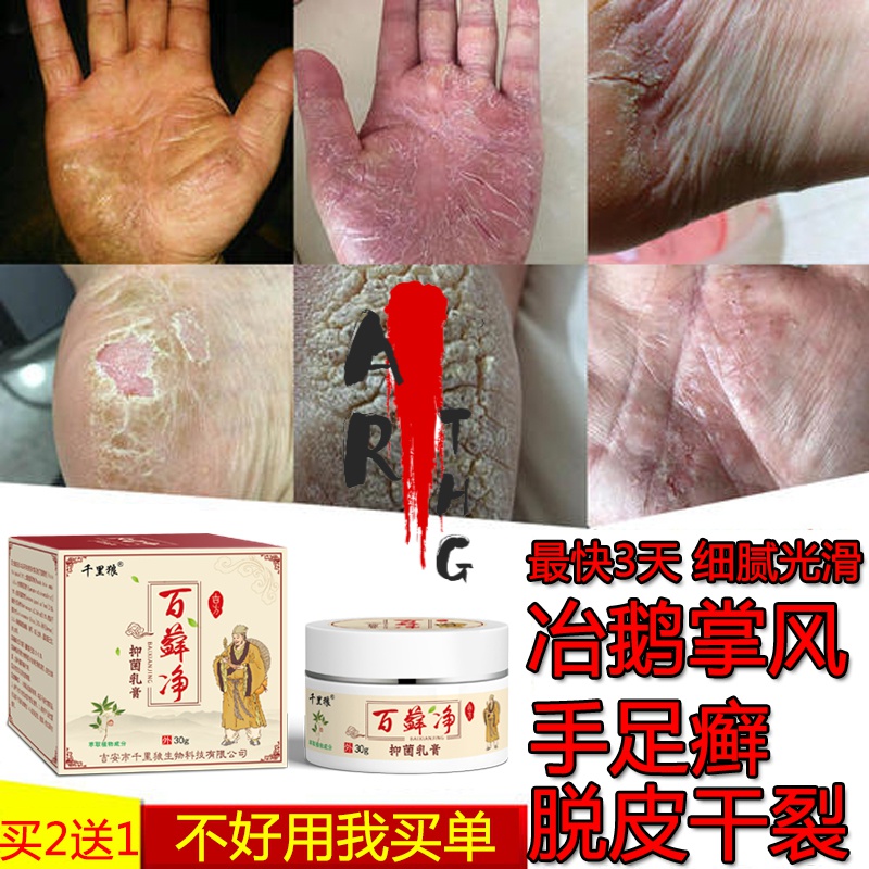 癣干裂脱皮全手部鹅掌风干裂脱皮外用脚裂修复霜起燥粗糙真菌感染专用