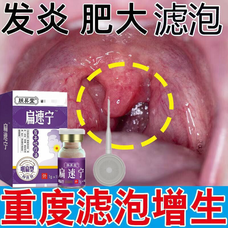 儿童成年人扁桃体发l炎咽扁桃体肥大肿大增生扁桃体化脓溃烂溃疡喷剂