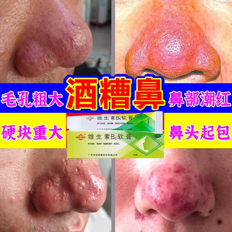 维生素b6软膏 酒糟鼻用药鼻头发红鼻子红肿长痘草莓鼻黑头粉刺 鼻头