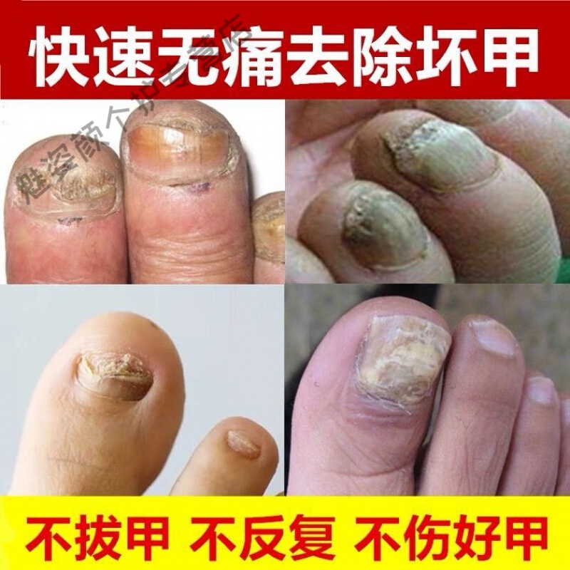 快速去灰指甲液【用一次就掉甲】脱厚甲用软甲膏灰甲净专用修复液亮岬