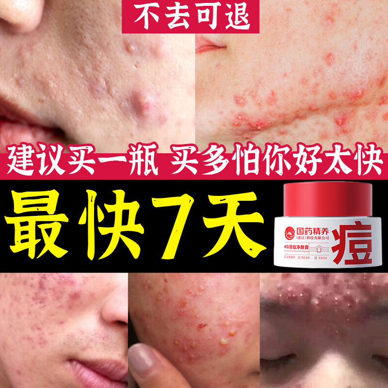 国药精养祛痘膏去痘疤淡化痘印痘坑修复痘肌亮肤青春痘40g