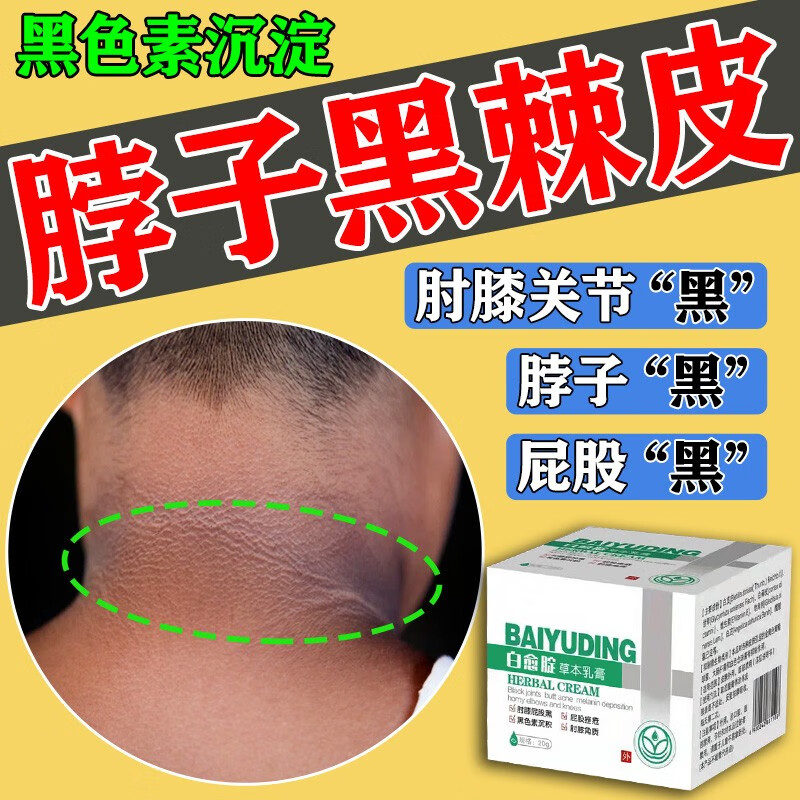 脖子关节黑棘皮病治黑色素去除美嫩白腋下手肘大腿内侧儿童磨砂乳 单