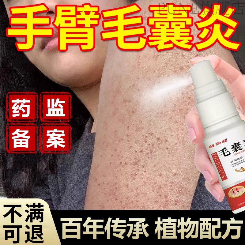 熏姿颜邹润安毛囊净胳膊上的小疙瘩手臂上长痘痘毛囊炎膏除螨粉刺鸡