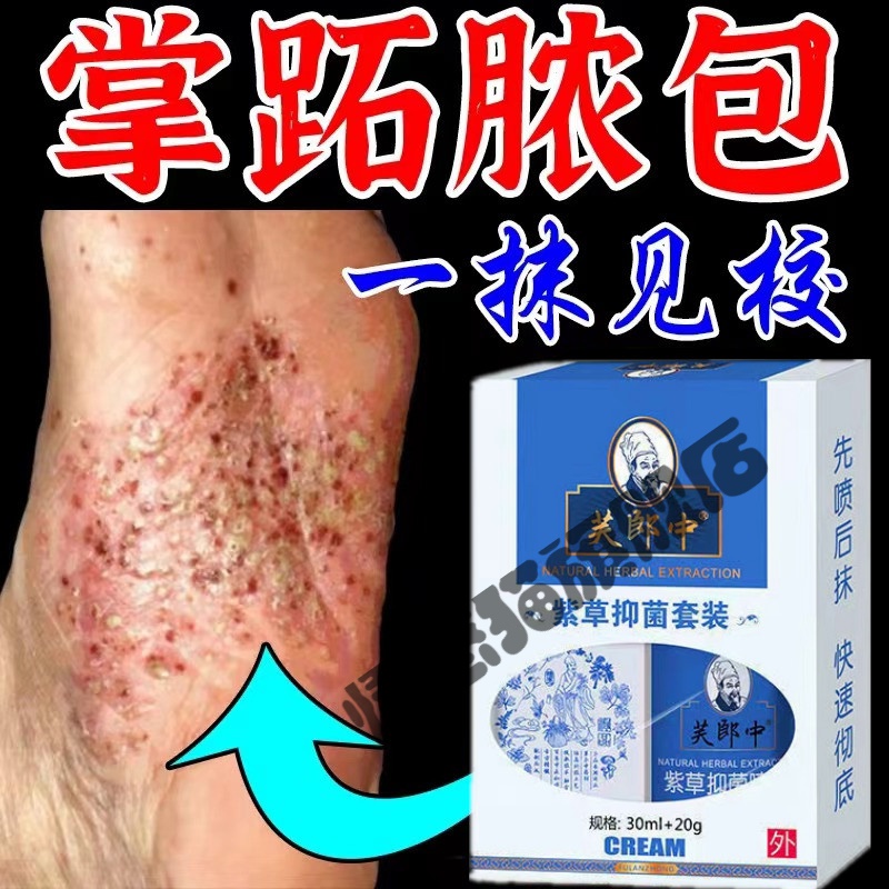 掌跖脓疱病手掌脓疱止痒乳膏喷雾掌趾脓手足干裂脱皮手掌脚掌起小水泡