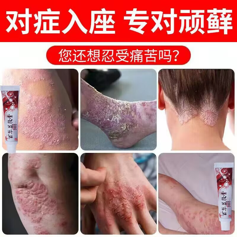 芙必康牛l皮l癣银l屑专用膏手l癣皮肤瘙痒湿l疹皮l炎瘙痒痒股体l癣膏