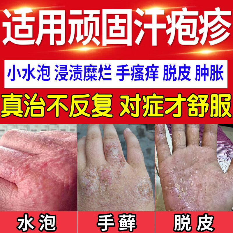 汗疱疹药膏 手上起小水泡手痒蜕皮真菌感染皮肤瘙痒皮炎湿疹各种湿疹