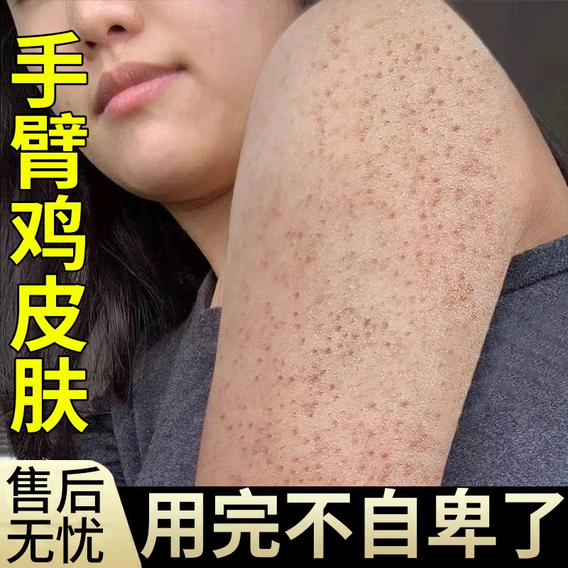 kkp鸡皮肤疙瘩毛囊角化去除手臂胳膊上腿上的小疙瘩大腿毛周角化症膏