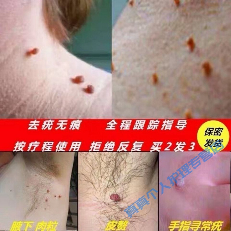 皮肤无疣膏软疣私处疣膏箹扁平i疣脸部疣疣必治除疣疣立净肉粒丝状i疣