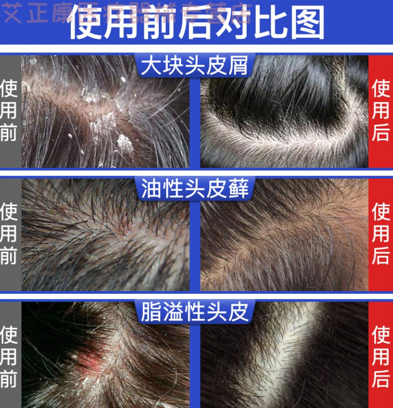头皮癣洗发水      大块头皮屑严重头痒藓癣屑真菌控油洗发水 控油