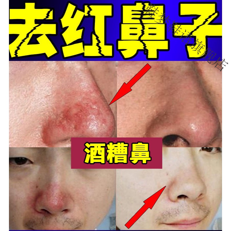 酒糟鼻修复红鼻子软膏祛除螨虫粉刺鼻螨清毛孔粗l大去酒渣鼻头红肿