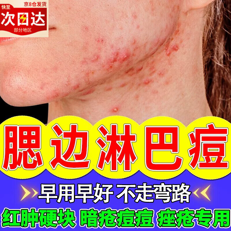 淋巴痘腮边痘脓包疮脖子下巴红肿硬块结节痘硬块痘痘消i炎专用凝 单盒