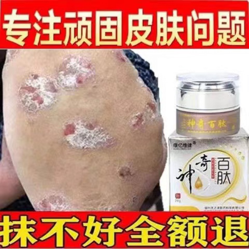 脓包疙瘩痤l疮痘痘薬膏红肿皮肤红点疙瘩脓点热痒脓疮性毛囊炎膏薬贴
