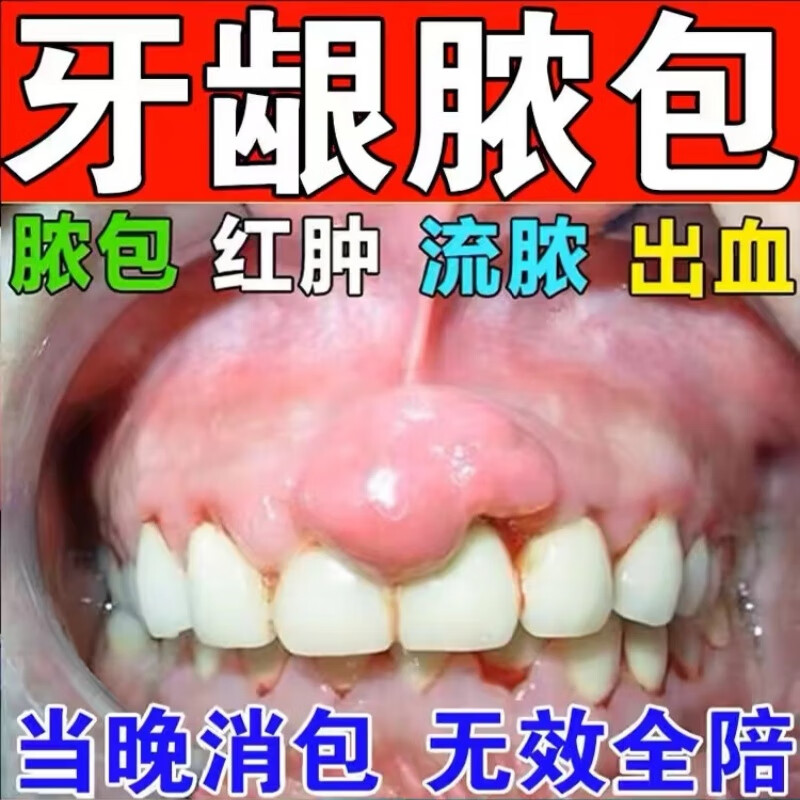 牙龈肿痛消炎药止痛牙龈肿痛消炎药牙根脓疱牙床牙龈疼脸肿智齿发炎
