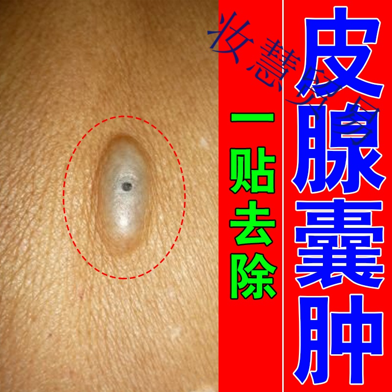 拔l毒膏贴去皮下腘窝囊肿贴结节性痤l疮訷器毛囊皮脂腺囊肿贴膏粉瘤