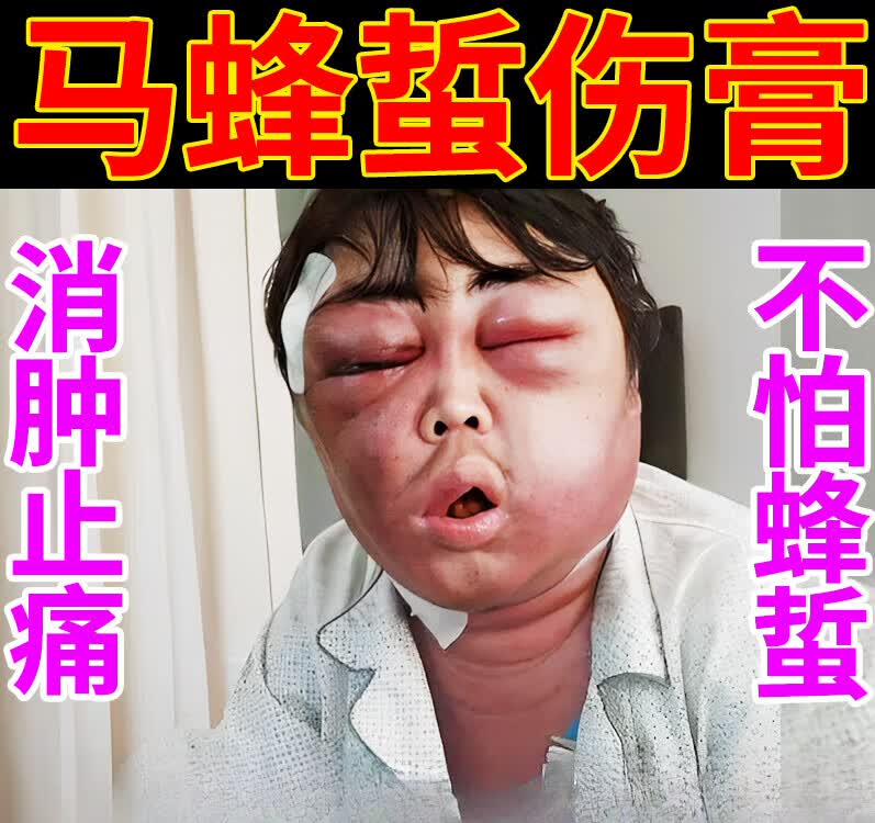 CLCEY马蜂蛰伤药膏人被蜜蜂王蜇咬养蜂专用工具消红肿止痛拔毒的药 单盒装怎么样,好用不?