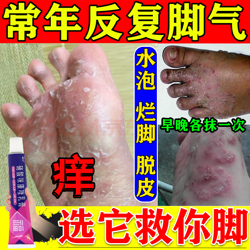 硝酸咪康唑乳膏 脚气药止痒脱皮烂脚丫真菌感染止痒 药膏 水泡糜烂