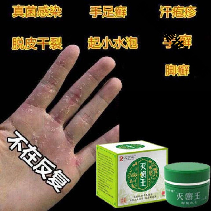 手l癣手足l癣真菌感染汗l疱l疹水泡手痒脱皮干裂湿l疹止痒膏鹅掌风 单