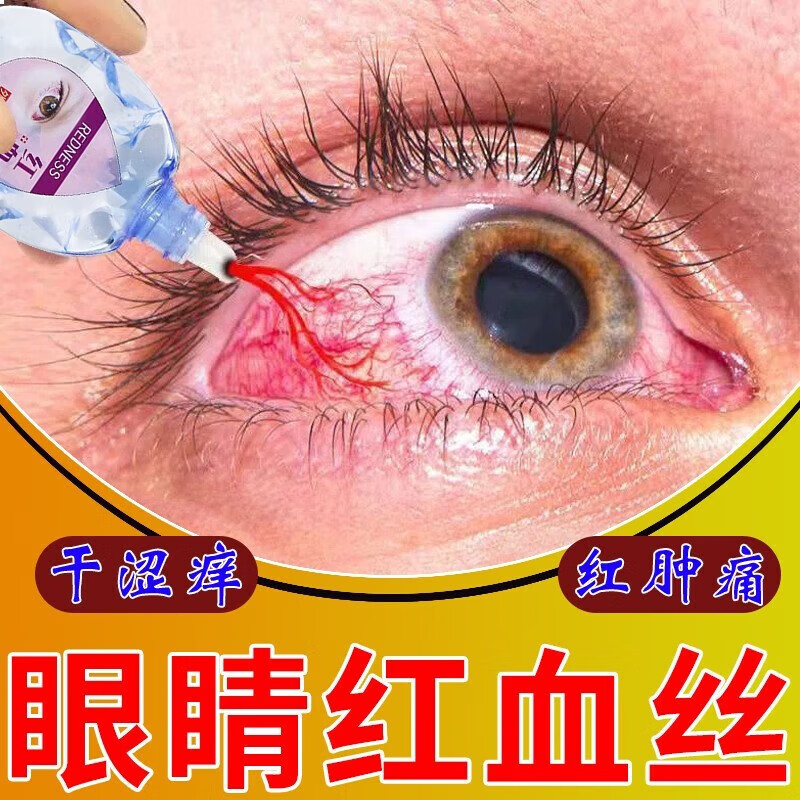 眼睛红血丝眼药水结膜充血红血丝迎风流泪过度模糊成人专用滴眼液 单
