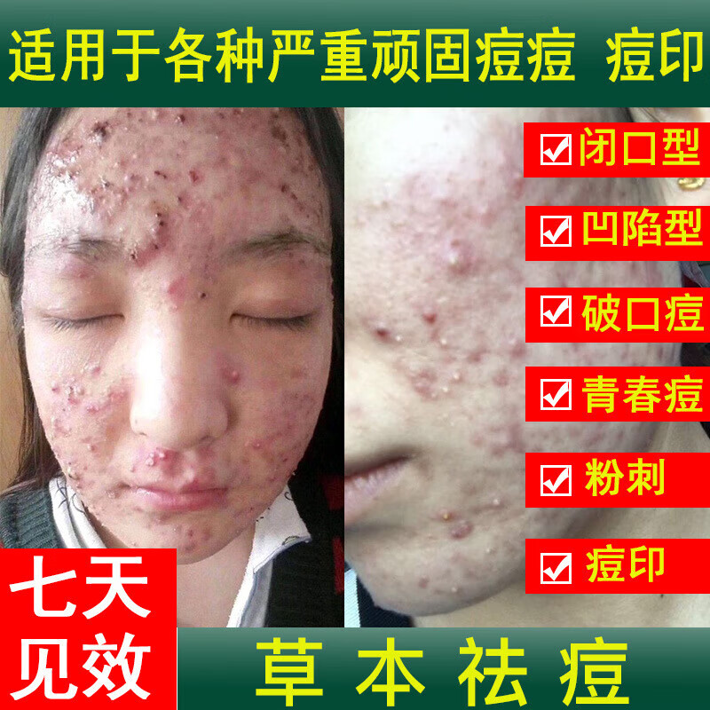 【药房直发】祛痘膏青春痘去粉刺男女学生淡化痘印痘疤霜消印修护痘坑