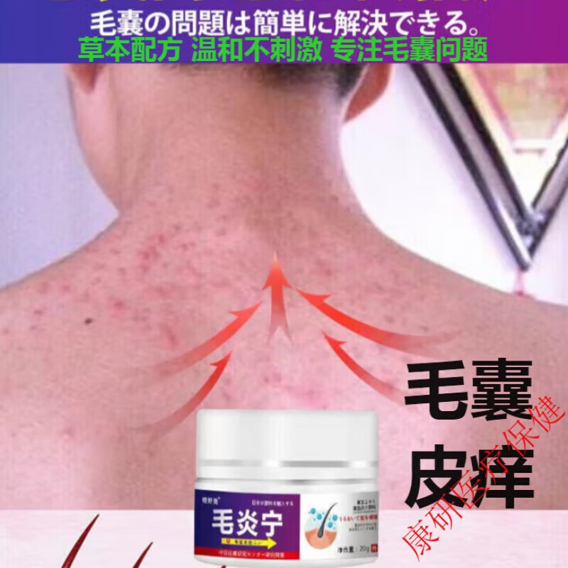 马拉色菌毛囊痒炎软膏头部背胸部脸部痘痘脓包痤仓脂溢性头皮痒头湿痒