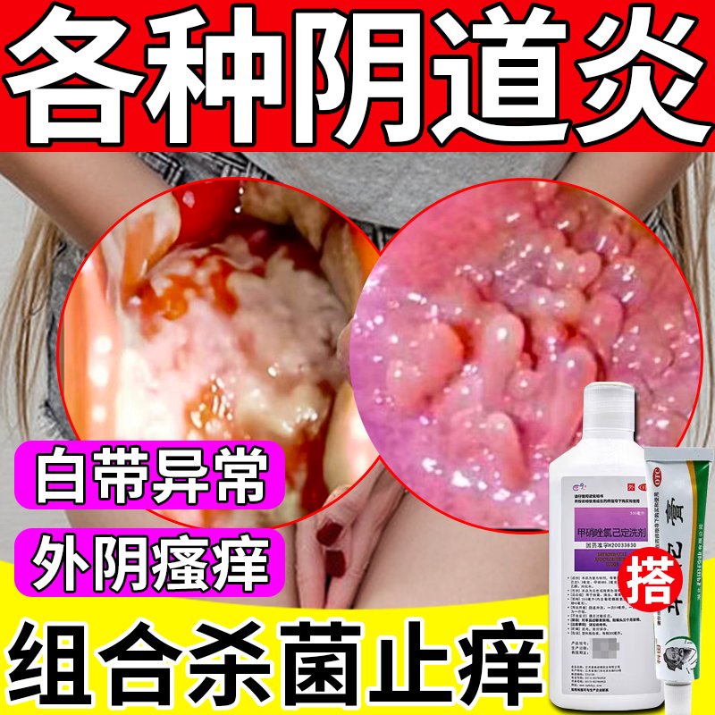 炎症性 瘙痒症外阴瘙痒妇科药治多种妇科洗液止痒杀菌炎症可搭消炎药