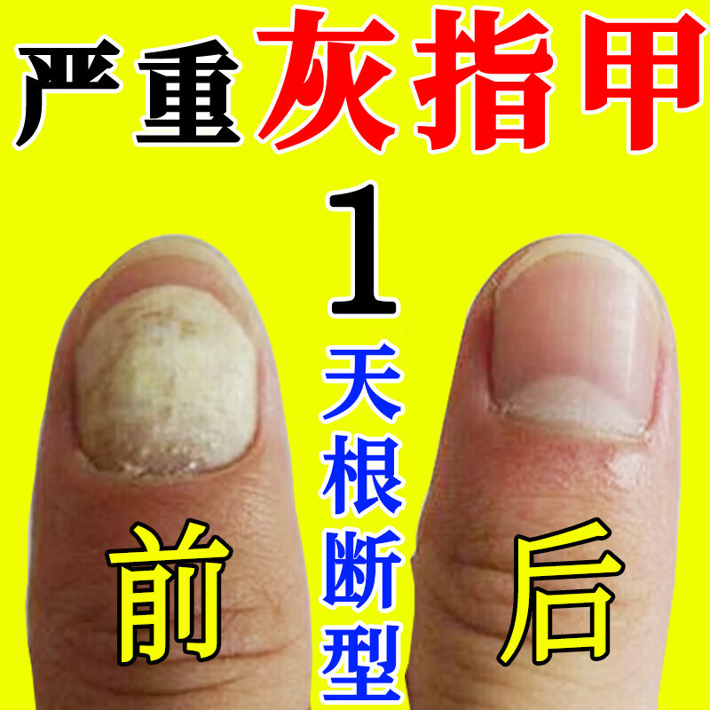 熏姿颜灰指甲特傚效药指甲真菌感染脱甲坏甲脚指甲增厚去除哏治正药灰