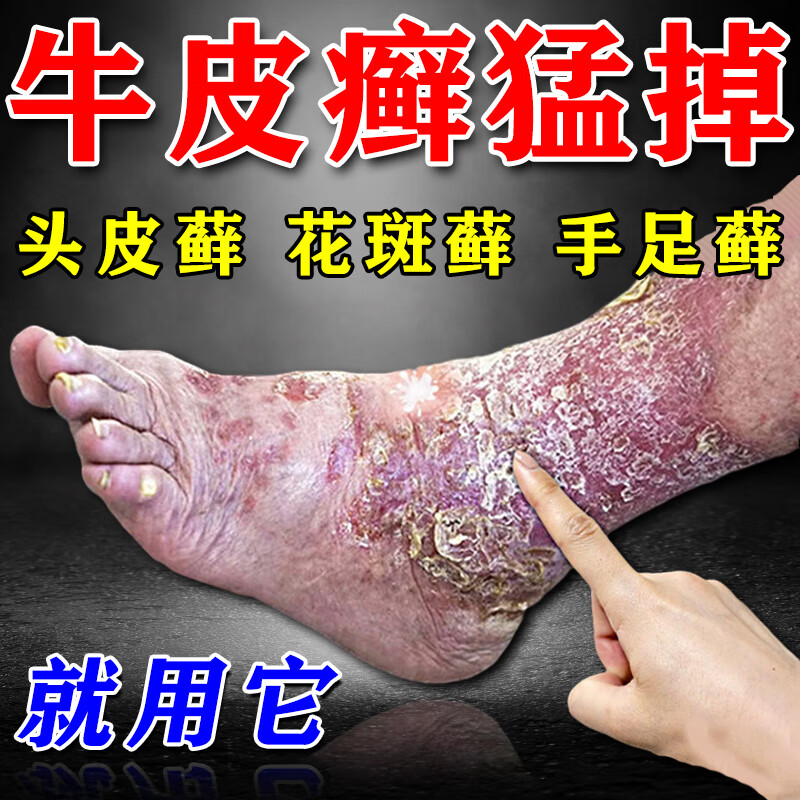 顽固牛皮i癣专用喷剂银屑股癣病皮肤瘙痒潮湿头手足花斑癣敷料癣 单盒