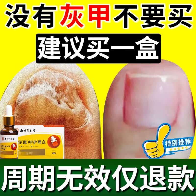 领航奉献灰指甲特殊效去除甲i沟i炎增厚发黄变空液中草药水灰甲 1盒装【1-2个推荐】高性价比高么？