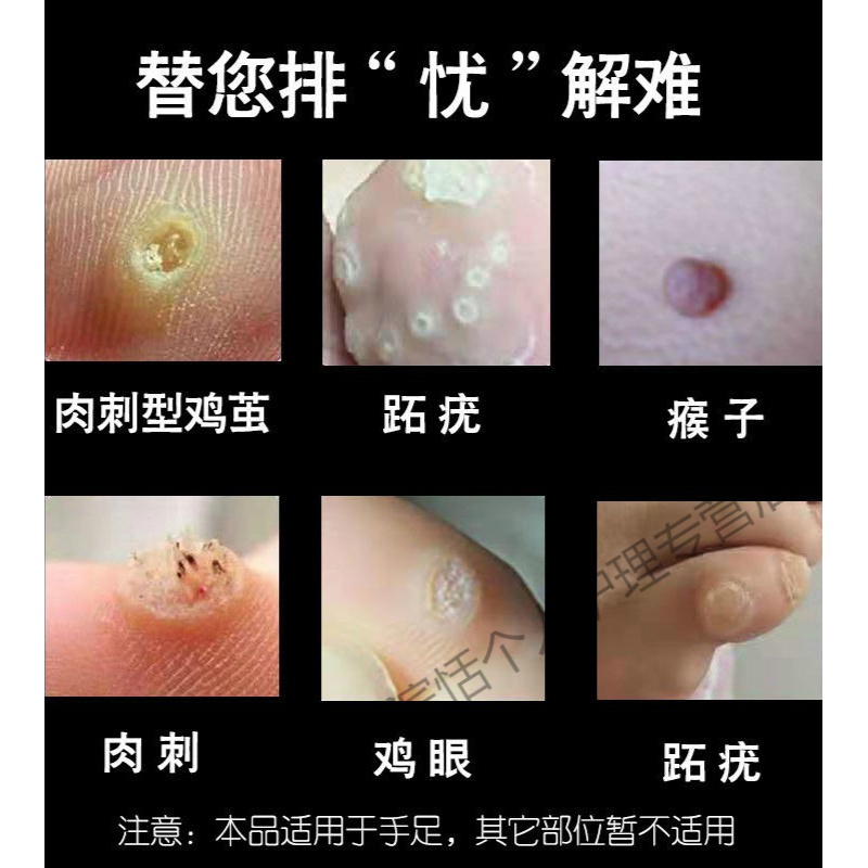 茧清膏老茧祛死皮脚垫跖l疣脚茧脚后跟肉l刺关节茧瘊l子无痛脱落 一