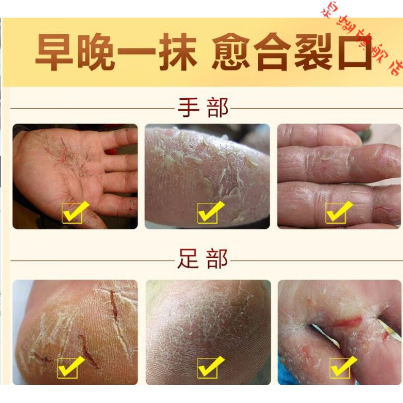 愈裂霜博山奥姿雪蜂蜜保湿霜脚后跟干裂修复霜皮肤开裂干燥手裂 1盒装 官方直售