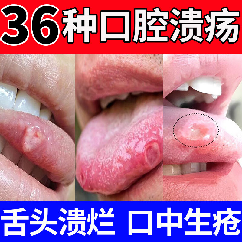 moomp益生菌牙膏口腔溃疡牙膏舌头口腔溃疡的专用牙膏凝胶鹿去异 一