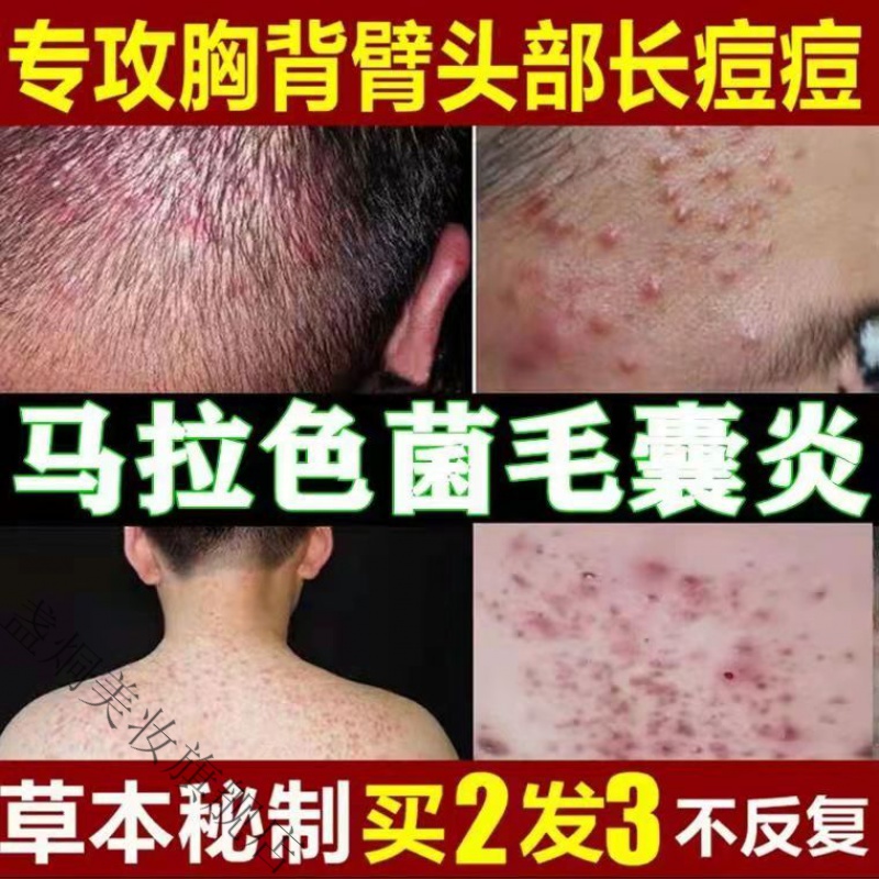 后背祛痘去背上痘痘背部痘痘印痘坑淡化消印去除粉刺男女訷器乳膏